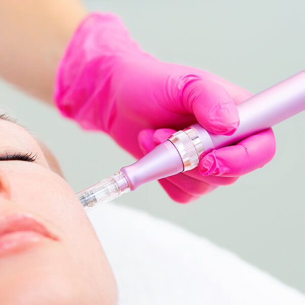 Micro-needling being allied to the face of a female patient.